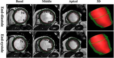 Association Between Left Ventricular Global Function Index and Outcomes in Patients With Dilated Cardiomyopathy